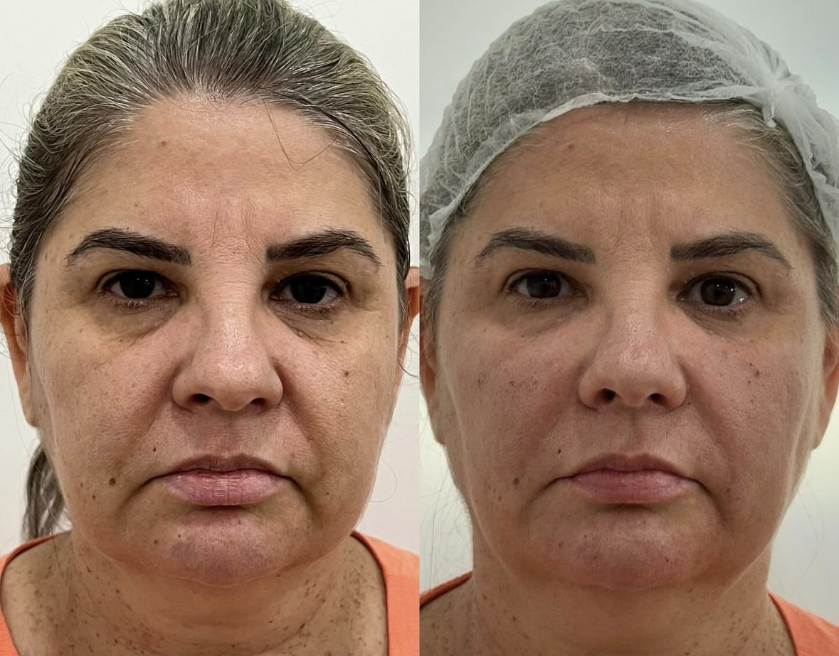 Before and After - Lymphatic Drainage: Swelling Reduction