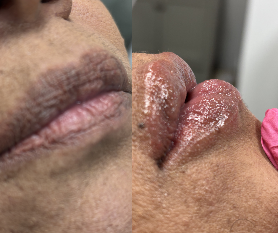 Before and After - Hydrolips: Hydrated Lips
