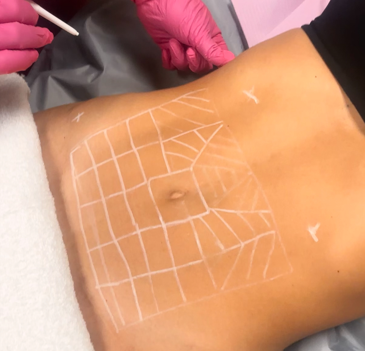 Mamma makeover weight lose treatment