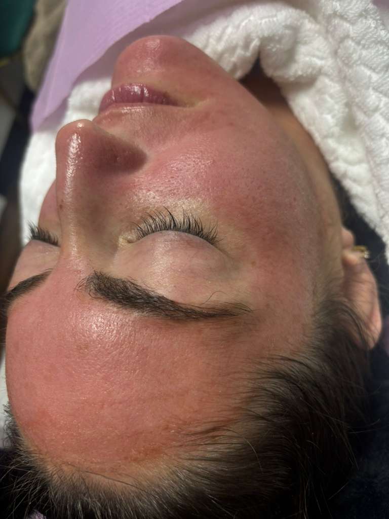 Microneedling with PDRN