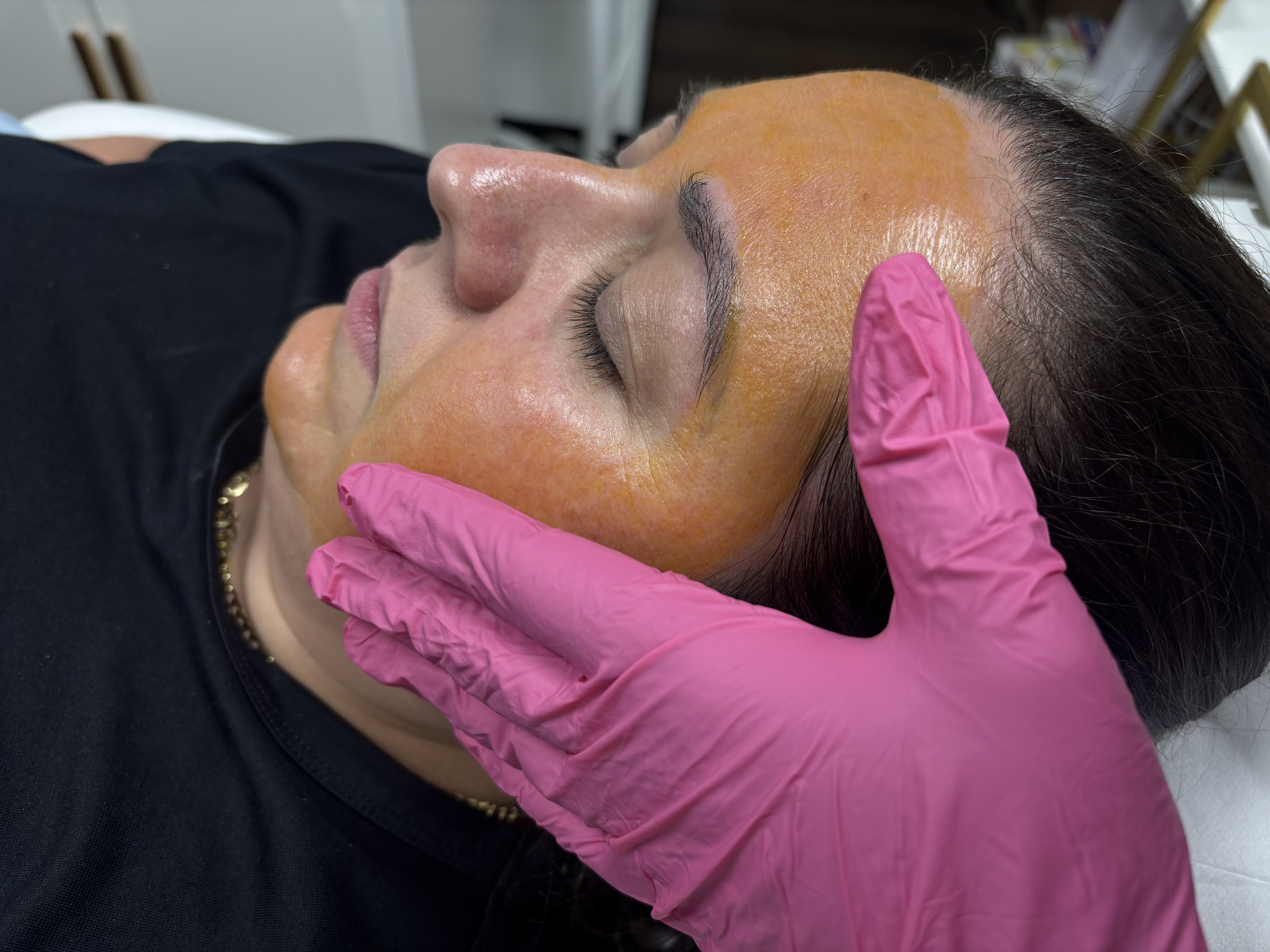 Before and After - Regenerative Peeling: Luminous Skin